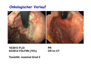 Onkologischer Verlauf
10/2013 FLO: PR
02/2014 FOLFIRI (75%) CR im CT
Toxizität: maximal Grad 2
 