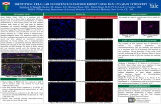 INTRODUCTION
A
IDENTIFYING CELLULAR SENESCENCE IN INJURED KIDNEY USING IMAGING MASS CYTOMETRY
▪ Human Kidney-2 (HK-2) cells were cultured in both 4
and 8 chamber slides and allowed to reach full
confluence after 3 days
▪ Cells were treated using Cyclosporine A (Cs-A) for 24
hours to induce senescence with concentrations of 5 μM,
10 μM, and 50 μM
▪ Immunostaining was performed on the HK-2 cells using
the anti-p21 antibody [EPR3993] with dilutions of 1:100,
1:300, and 1:500
▪ Results were analyzed through immunofluorescence
(40x) using the Alexa 546 dye (red)
Acute Kidney Injury (AKI) is a condition that is
characterized by a sharp drop in glomerular filtration.
Despite much research in the renal field, there is a limited
understanding of acute tubular injury, the most common
intrinsic renal cause of AKI, and thus no effective
treatments are currently available. Although previous
technologies to investigate human kidney biopsies has been
limiting, Imaging Mass Cytometry (IMC) is novel in that it
allows for detection and quantification of more than 40
protein markers on a single section of formalin-fixed,
paraffin-embedded tissue. Cell senescence refers to cells
that have undergone permanent and irreversible cell-cycle
arrest and have adopted an alternative secretory
phenotype. In animal models, p21, a cyclin-dependent
kinase inhibitor, is upregulated following AKI leading to
blocking the cell cycle at the G1/S phase causing telomere
shortening and DNA damage. The ability to detect human
p21 was therefore studied with the ultimate goal of
performing comparative immunostaining for p21 in both
injured and control human kidney biopsy specimens.
1Andrade, L., Rodrigues, C. E., Gomes, S. A., & Noronha, I.
L. (2018). Acute kidney injury as a condition of renal
senescence. Cell transplantation, 27(5), 739-753.
2Jennings, P., Koppelstaetter, C., Aydin, S., Abberger, T.,
Wolf, A. M., Mayer, G., & Pfaller, W. (2007). Cyclosporine A
induces senescence in renal tubular epithelial
cells. American Journal of Physiology-Renal
Physiology, 293(3), F831-F838.
3Singh, N., Avigan, Z. M., Kliegel, J. A., Shuch, B. M.,
Montgomery, R. R., Moeckel, G. W., & Cantley, L. G. (2019).
Development of a 2-dimensional atlas of the human kidney
with imaging mass cytometry. JCI insight, 4(12).
Sanidhya D. Tripathi; Zachary M. Avigan, B.S.; Marlene Weiss, M.D.; Nikhil Singh, M.D., Ph.D.; Lloyd G. Cantley, M.D.
Section of Nephrology, Department of Internal Medicine, Yale School of Medicine, New Haven, CT, USA
The authors would like to thank research support from the
National Institute of Diabetic and Digestive and Kidney
Diseases sponsored (Re)Building a Kidney, Diabetic
Complications Consortium, and the Yale Summer
Undergraduate Medical Research Program.
Figure 1. Human kidney morphology via IMC.
METHODS
CONCLUSIONS AND FUTURE WORK
REFERENCES
The purpose of this research was to determine a
marker for cellular senescence via
immunofluorescence. The p21 antibody was observed
to be increased with Cs-A treatment and localized in
the cytoplasm. Future directions of this study could
include performing qPCR and Western Blots to assess
the expression levels of p21 and validate the antibody
tested.
ACKNOWLEDGMENTS
RESULTS
Figure 3. HK-2 cells treated with 10 μM Cs-A and immunostained with 2º antibody alone.
Figure 5. HK-2 cells treated with 10 μM Cs-A and immunostained with 1º and 2º antibodies.
RESULTS CONT.
Figure 6. Control
pMLKL.
Figure 7. Necroptosis
pMLKL.
An example of a positive antibody signal that is usable for
IMC.
DAPI (BLUE) – NUCLEAR STAIN ALEXA 546 (RED) – SECONDARY FOR ANTI-P21
Figure 4. HK-2 cells treated with vehicle and immunostained with 1º and 2º antibodies.
Figure 2. HK-2 cells treated with 10 μM Cs-A and immunostained with 1º antibody alone.
A
A
A
A
B
B
B
B
 