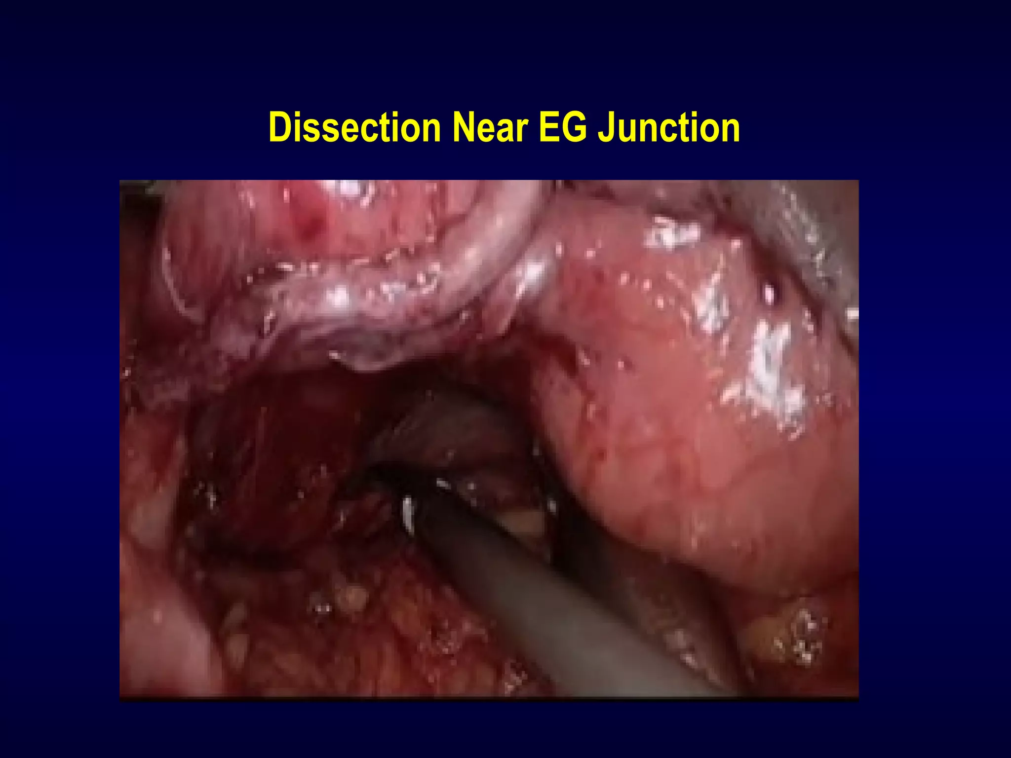 Dissection Near EG Junction
 