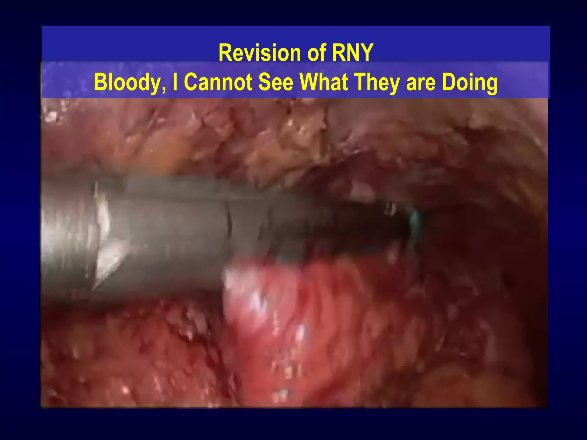 Revision of RNY
Bloody, I Cannot See What They are Doing
 