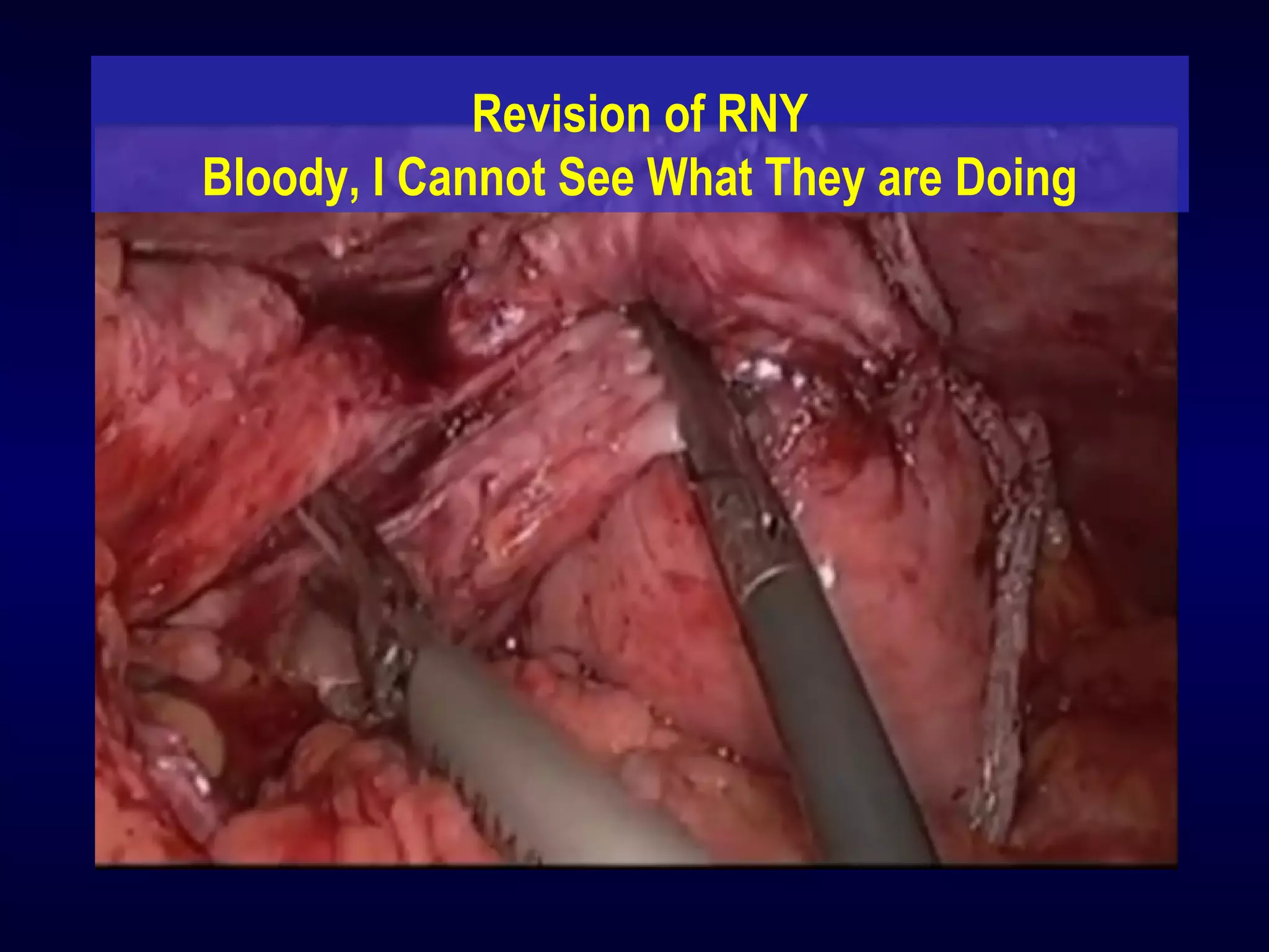 Revision of RNY
Bloody, I Cannot See What They are Doing
 