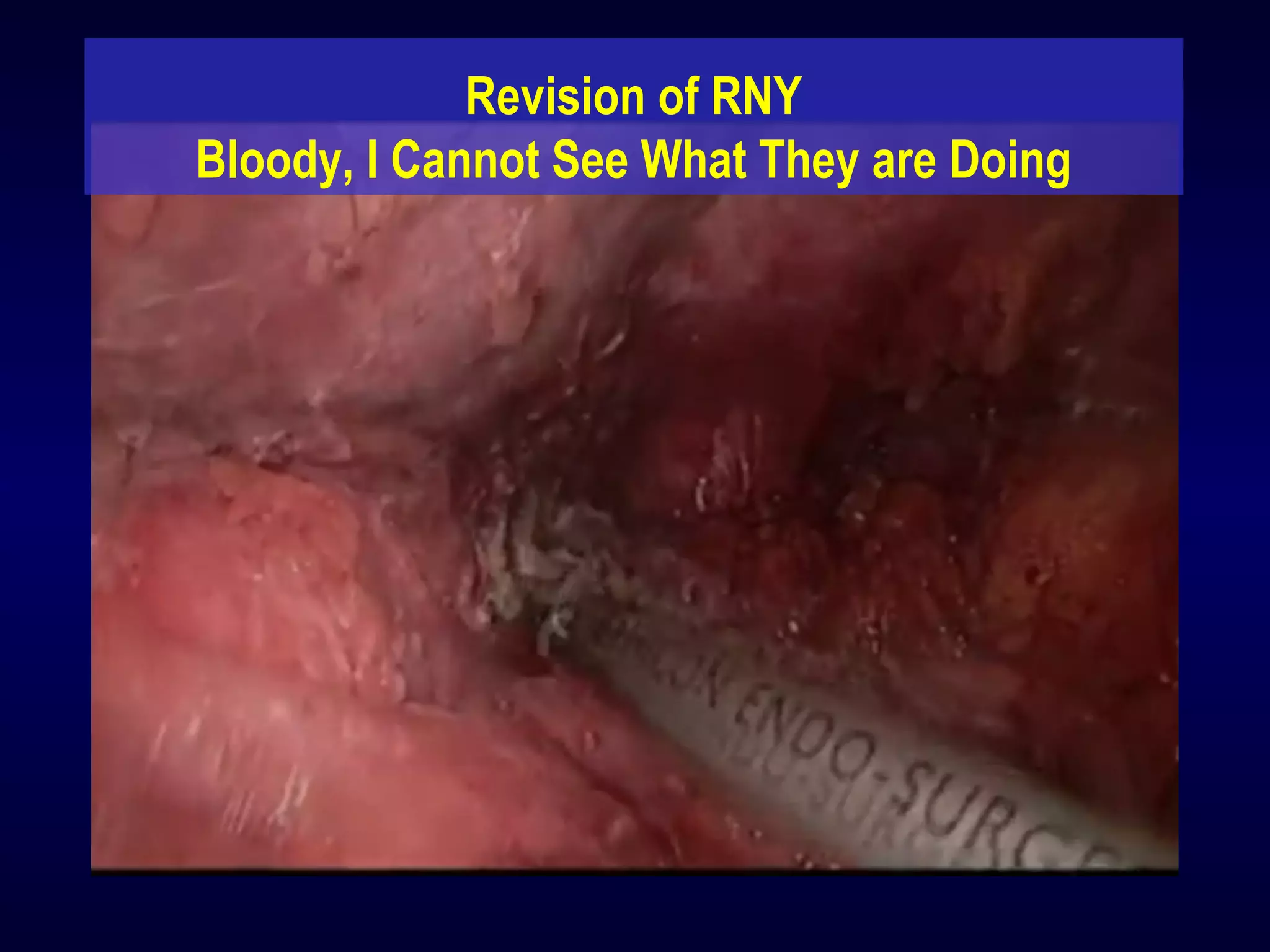 Revision of RNY
Bloody, I Cannot See What They are Doing
 