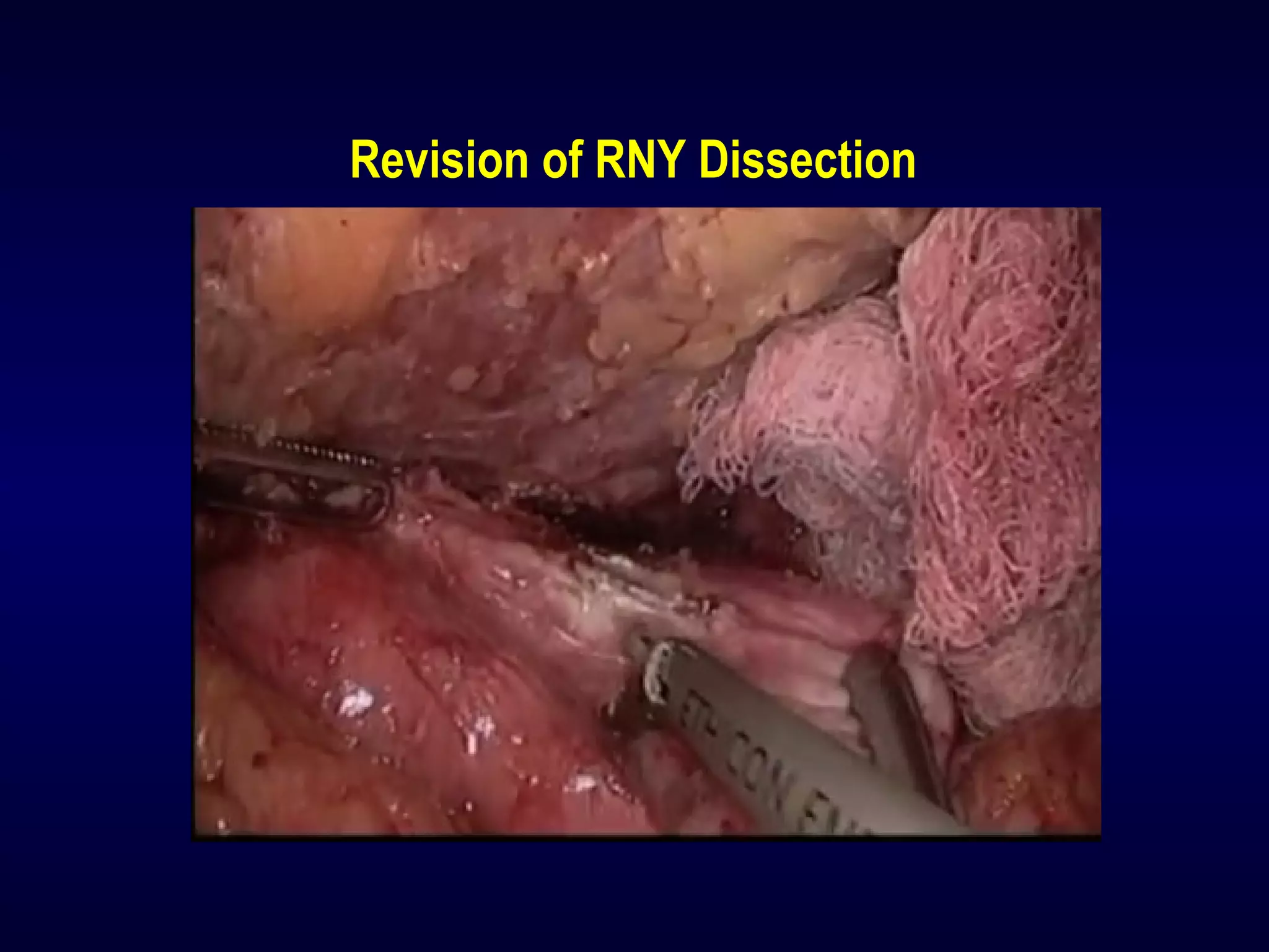 Revision of RNY Dissection
 