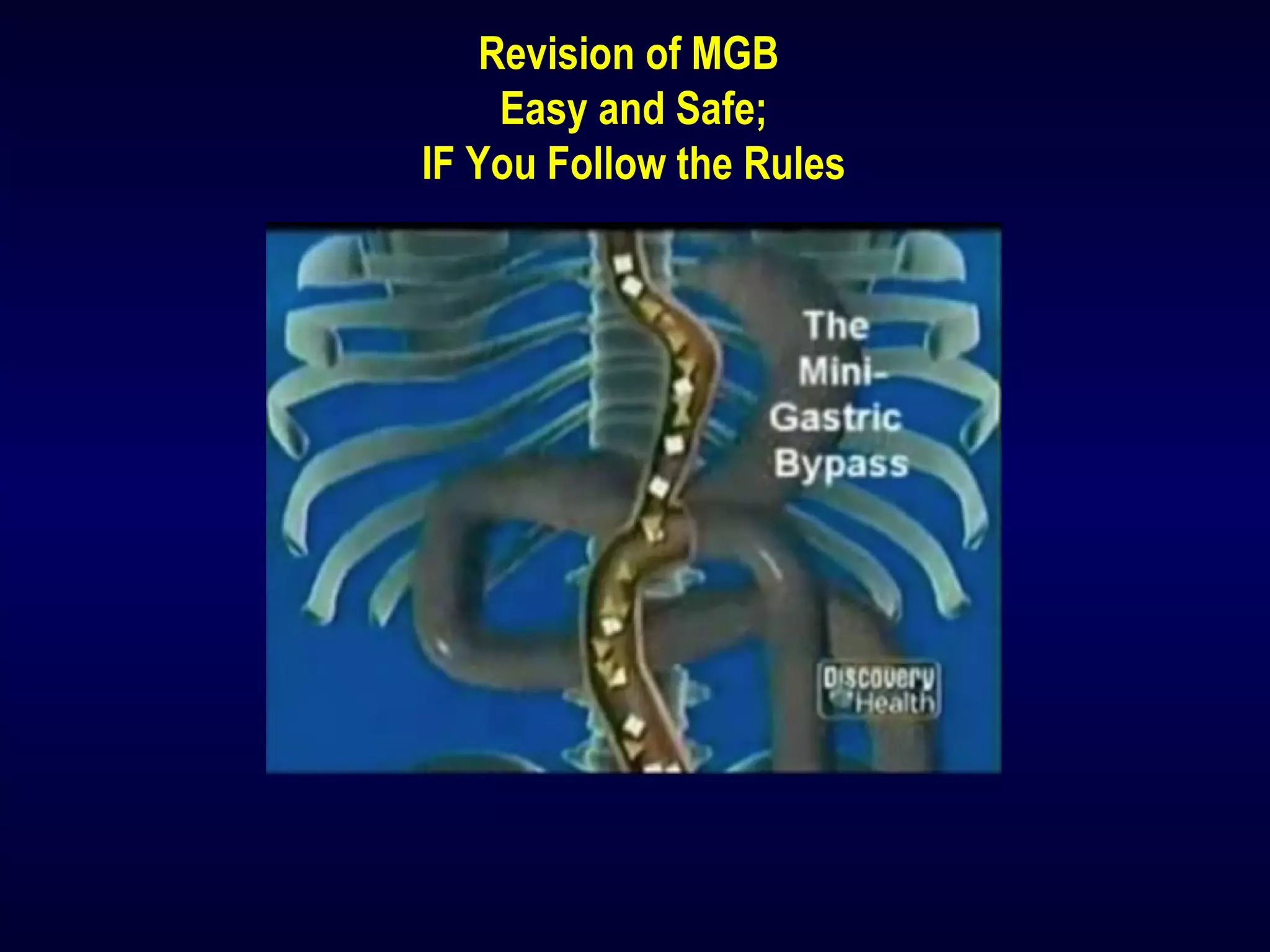 Revision of MGB
Easy and Safe;
IF You Follow the Rules
 