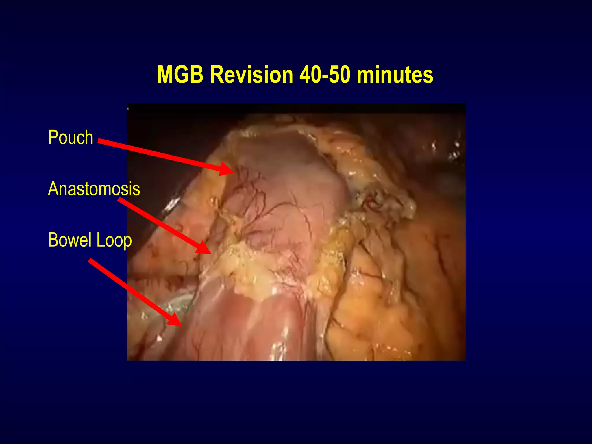 MGB Revision 40-50 minutes
Pouch
Anastomosis
Bowel Loop
 