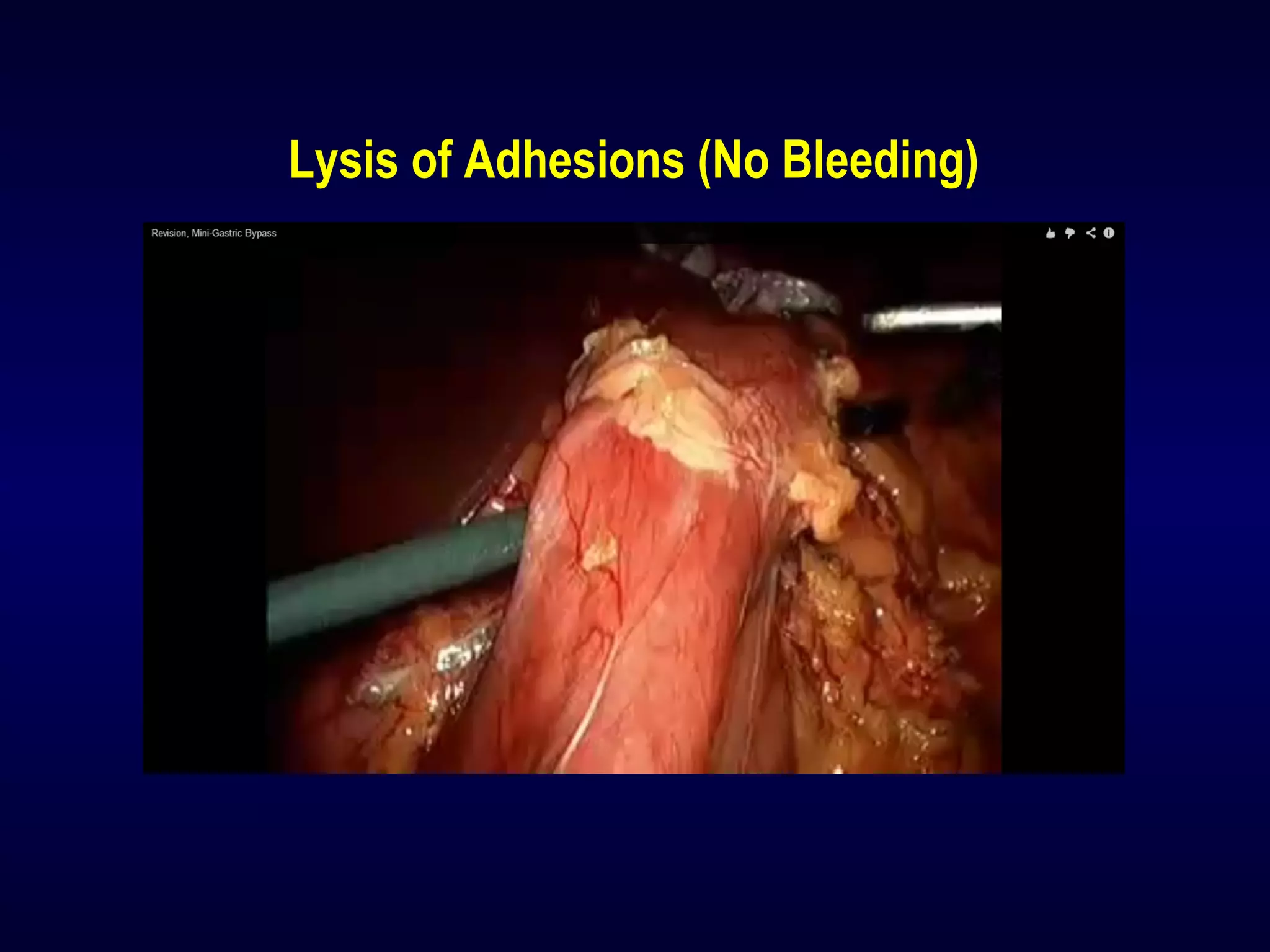 Lysis of Adhesions (No Bleeding)
 