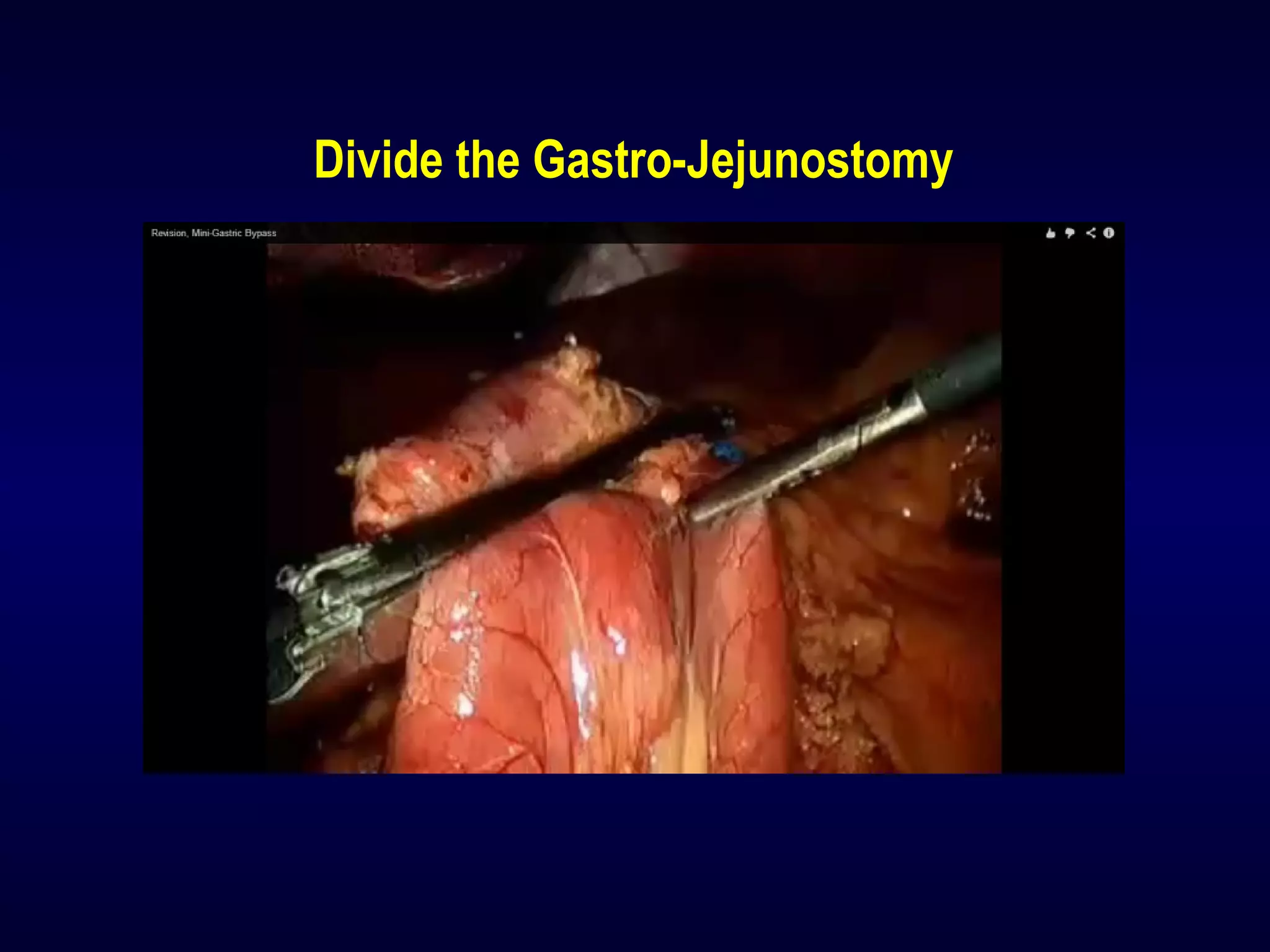 Divide the Gastro-Jejunostomy
 