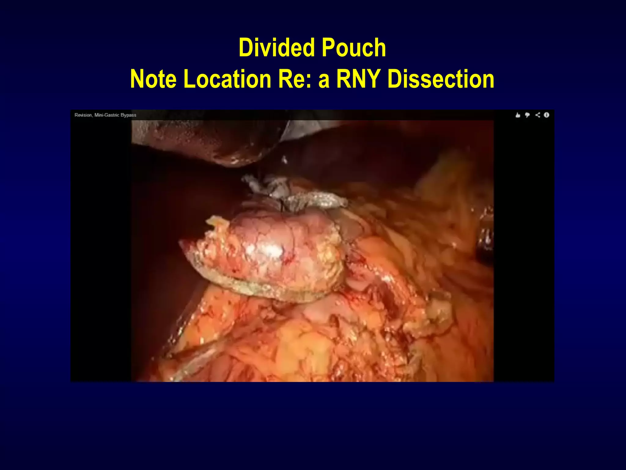 Divided Pouch
Note Location Re: a RNY Dissection
 