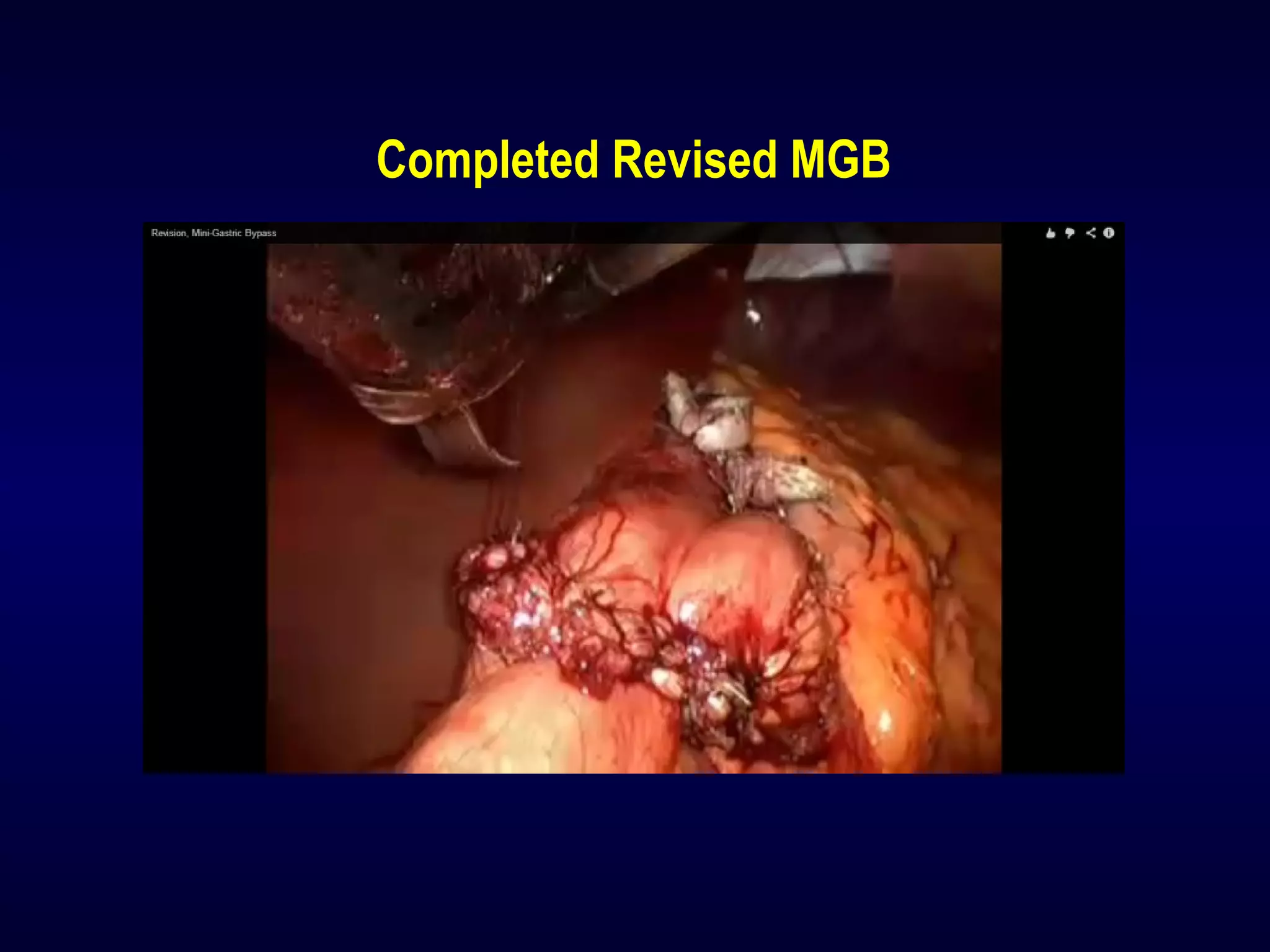 Completed Revised MGB
 