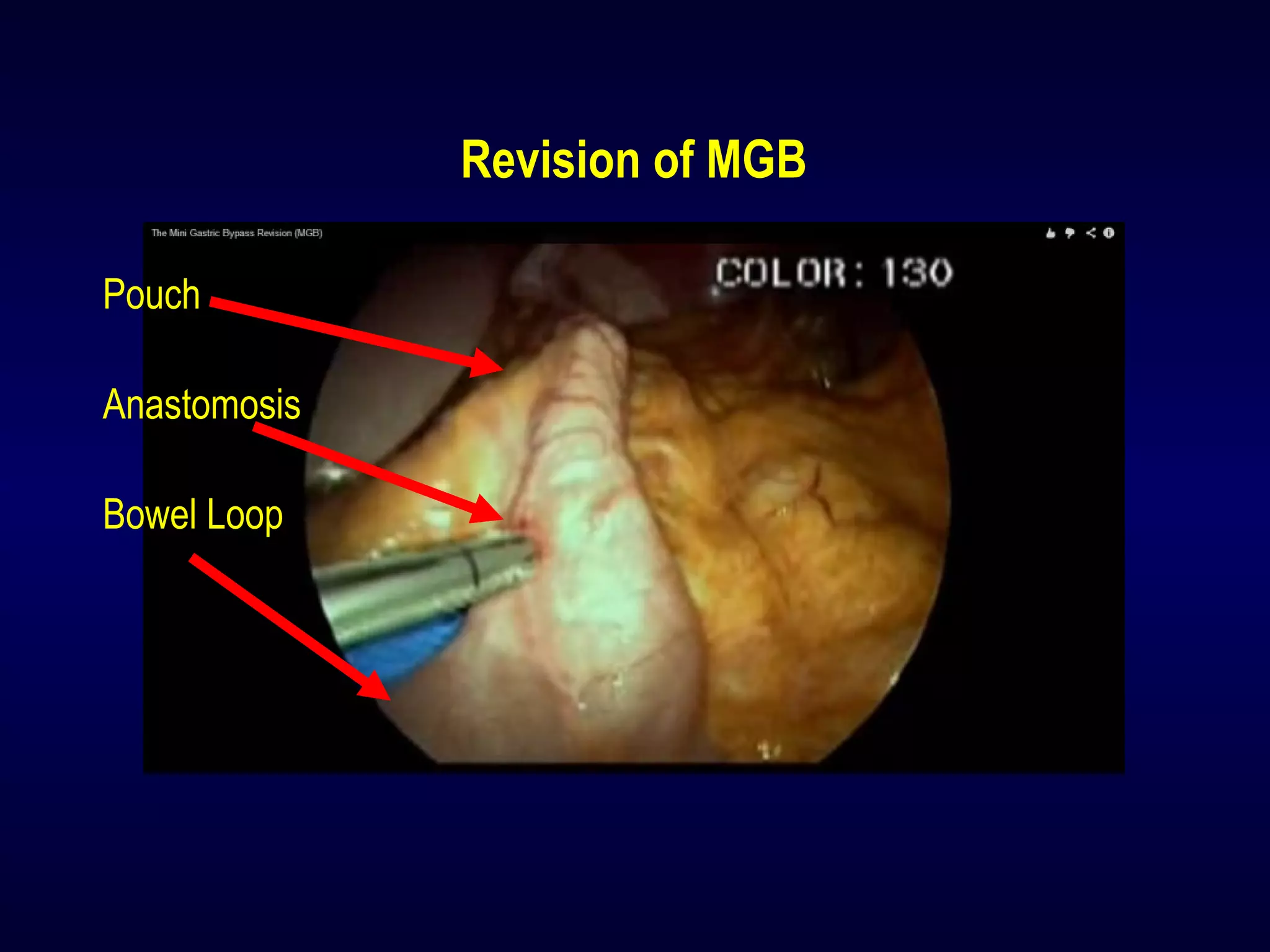 Revision of MGB
Pouch
Anastomosis
Bowel Loop
 