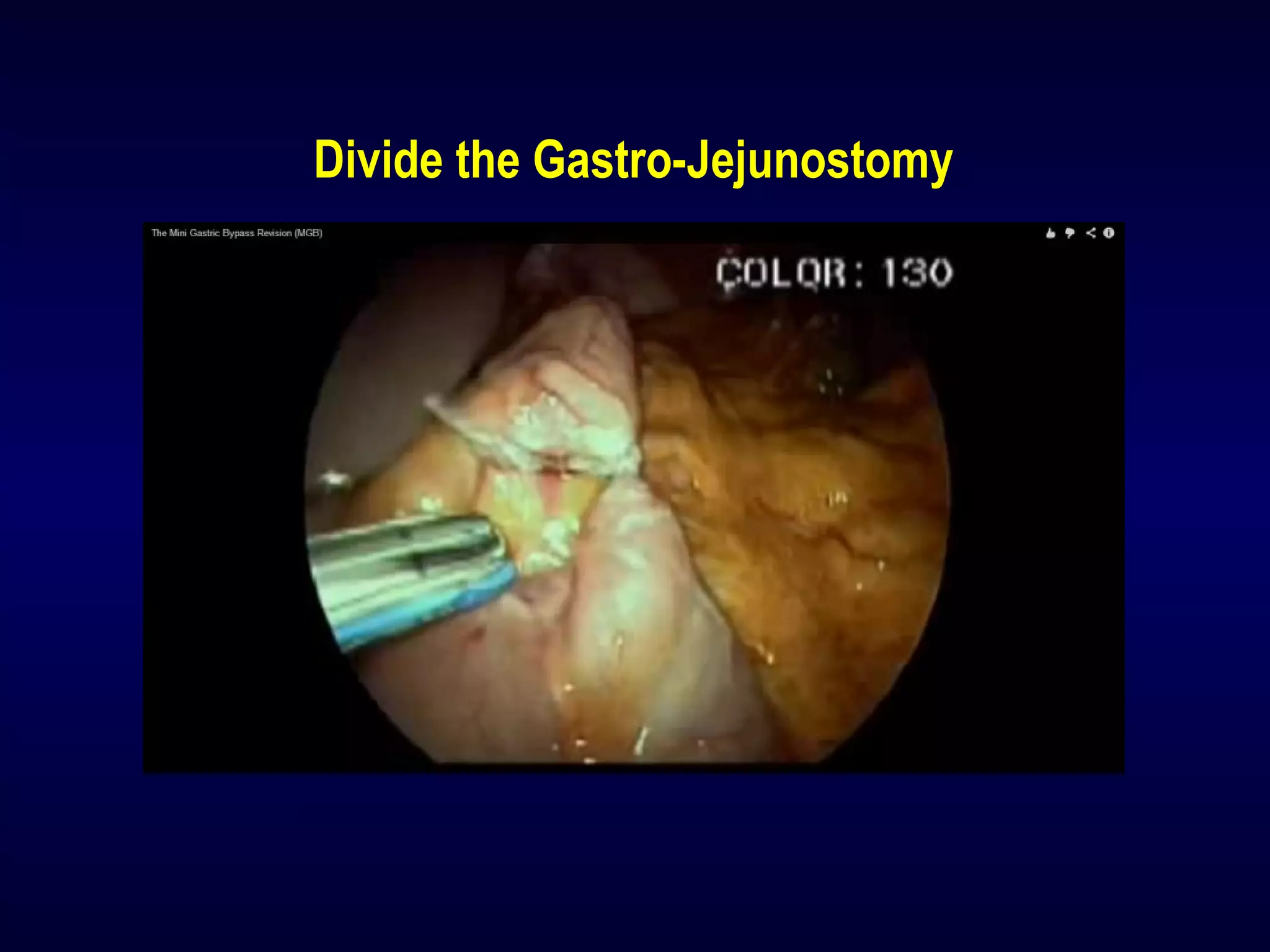 Divide the Gastro-Jejunostomy
 