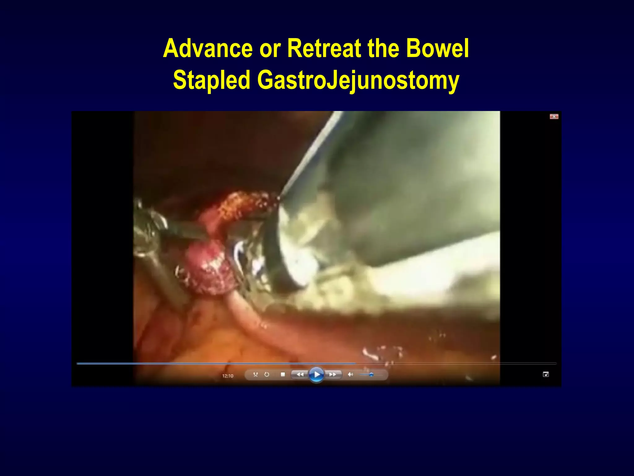 Advance or Retreat the Bowel
Stapled GastroJejunostomy
 