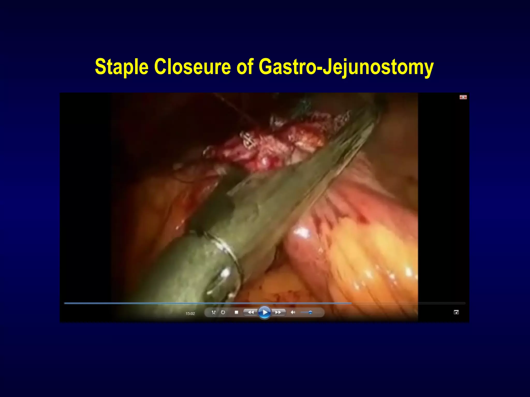 Staple Closeure of Gastro-Jejunostomy
 