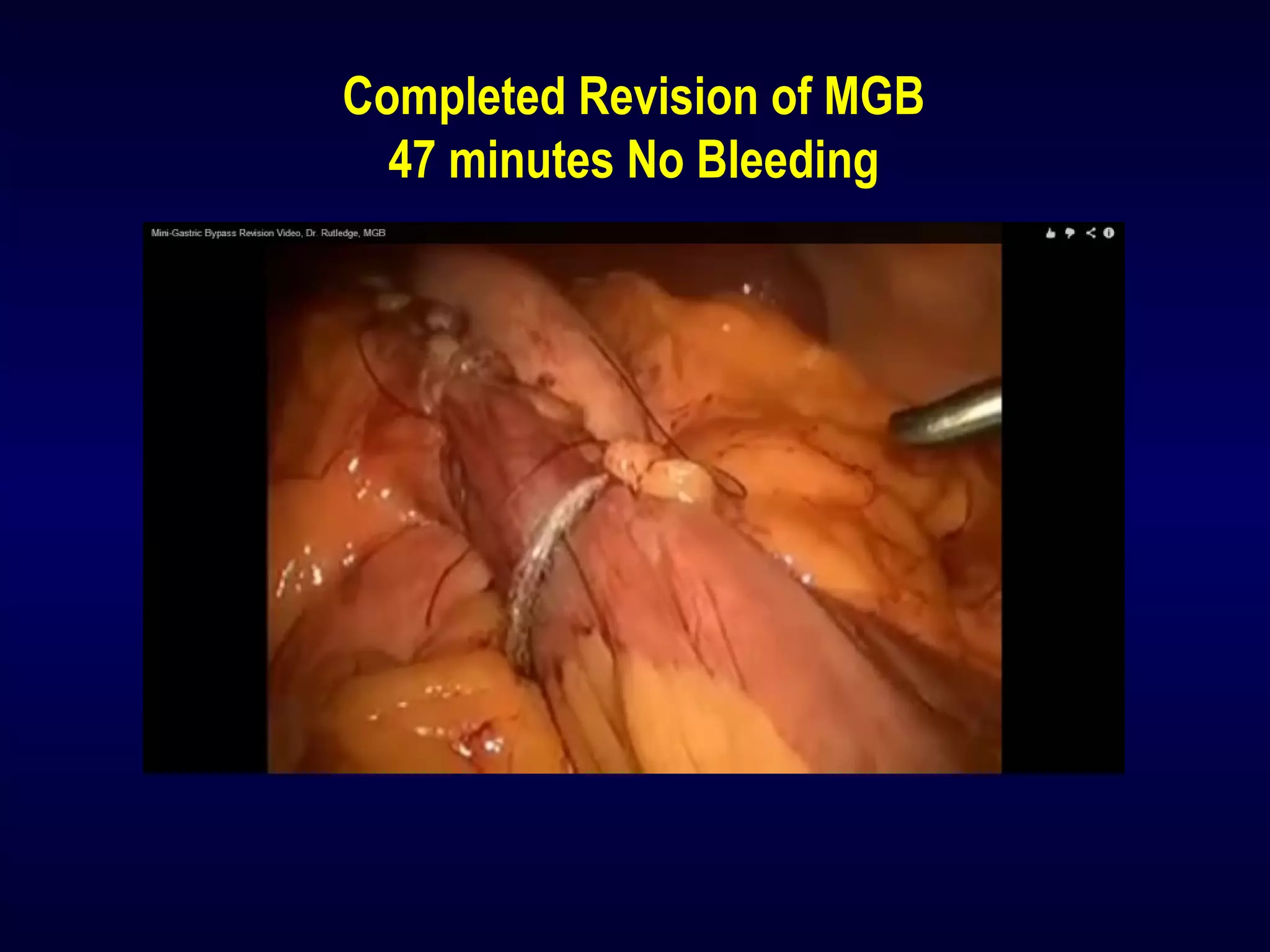 Completed Revision of MGB
47 minutes No Bleeding
 