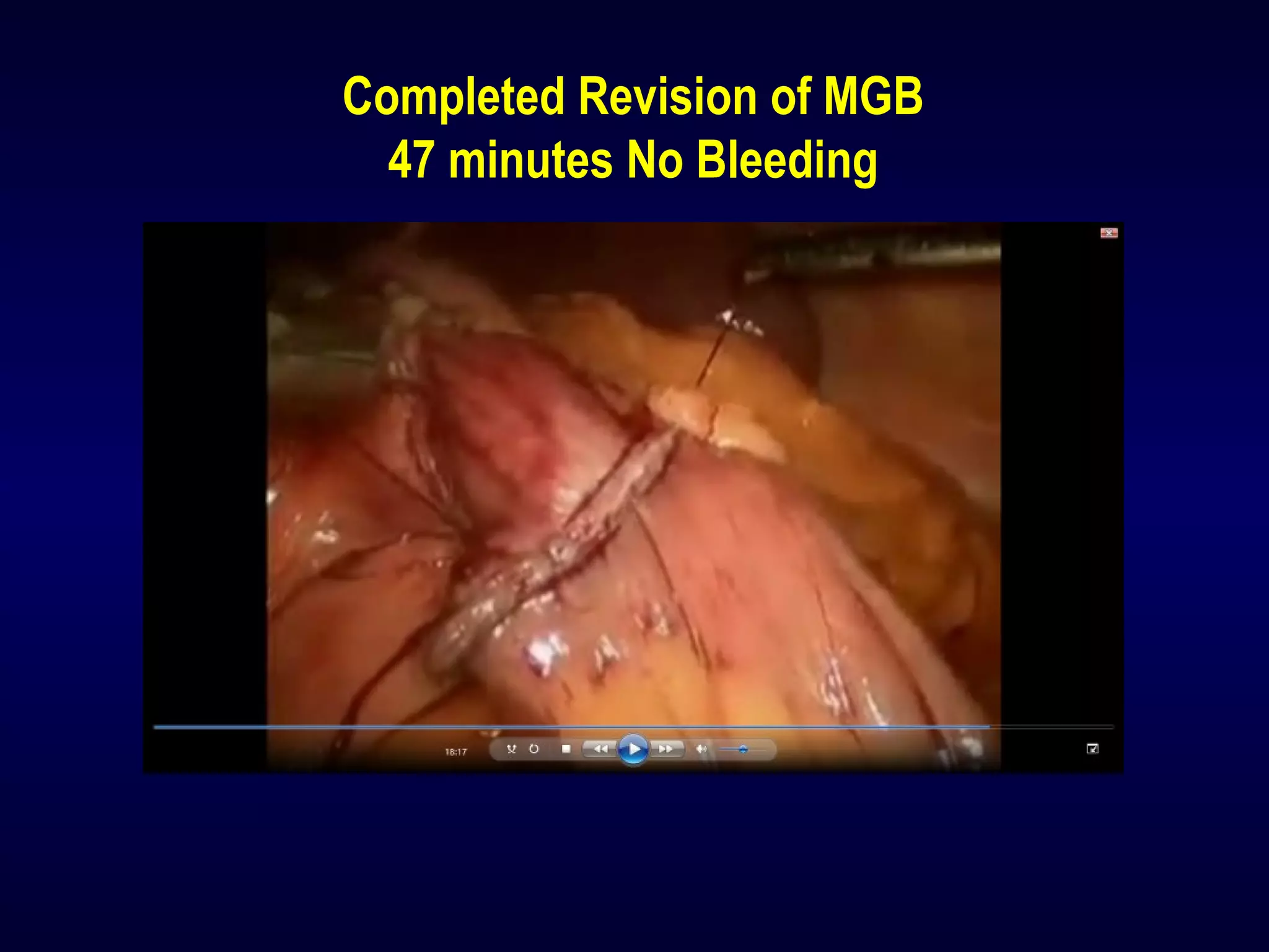 Completed Revision of MGB
47 minutes No Bleeding
 
