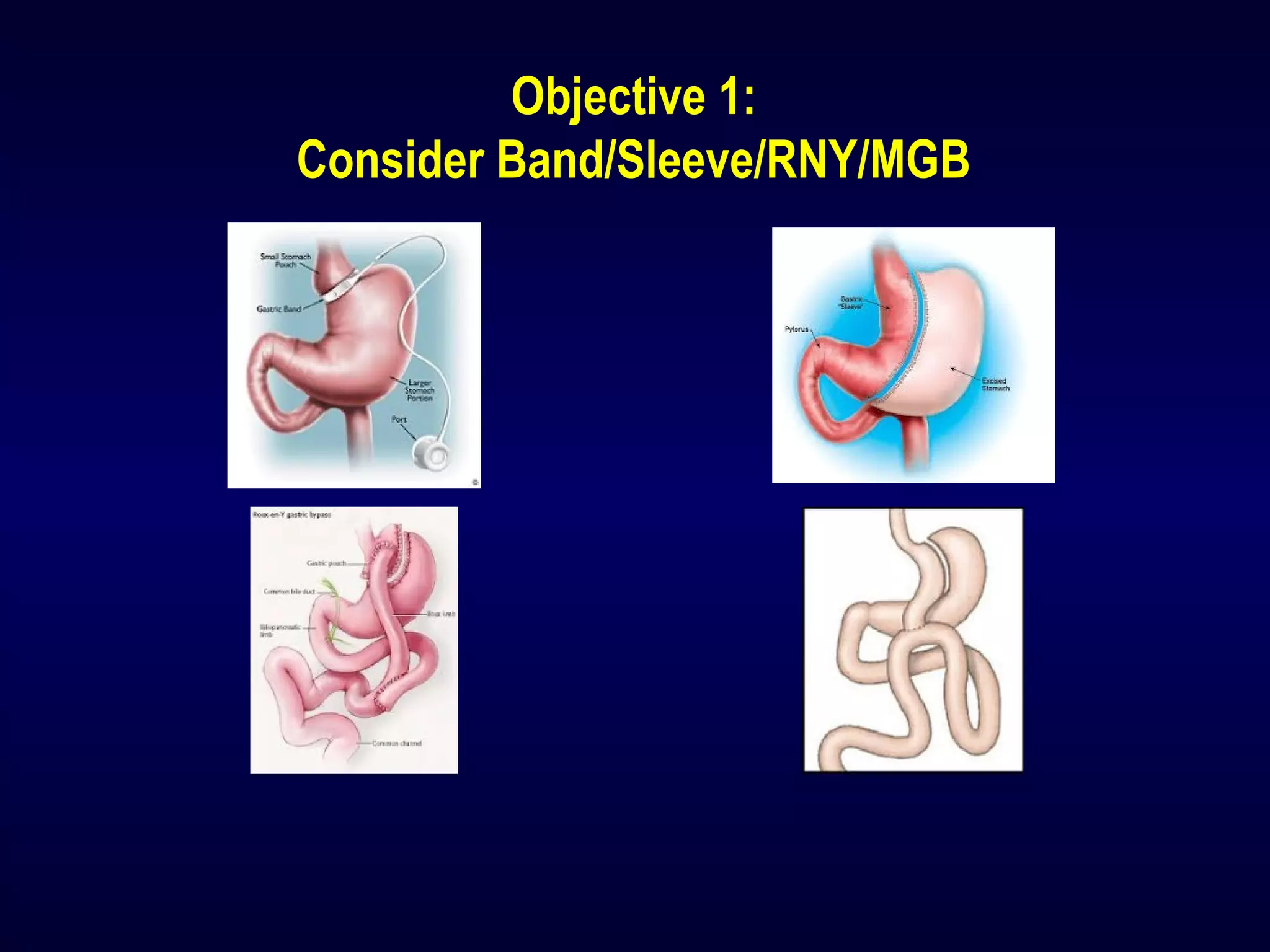 Objective 1:
Consider Band/Sleeve/RNY/MGB
 