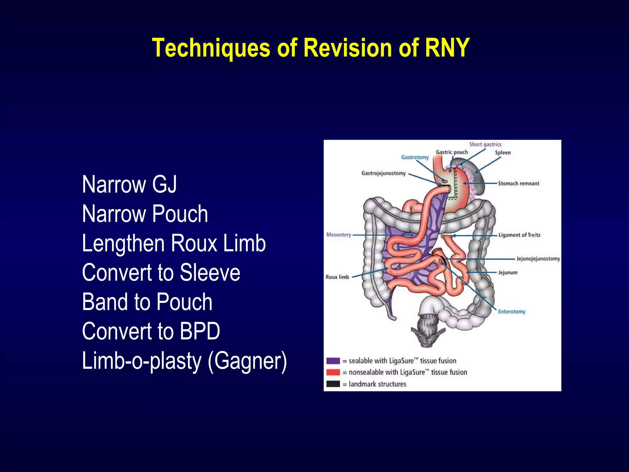 Techniques of Revision of RNY
Narrow GJ
Narrow Pouch
Lengthen Roux Limb
Convert to Sleeve
Band to Pouch
Convert to BPD
Limb-o-plasty (Gagner)
 