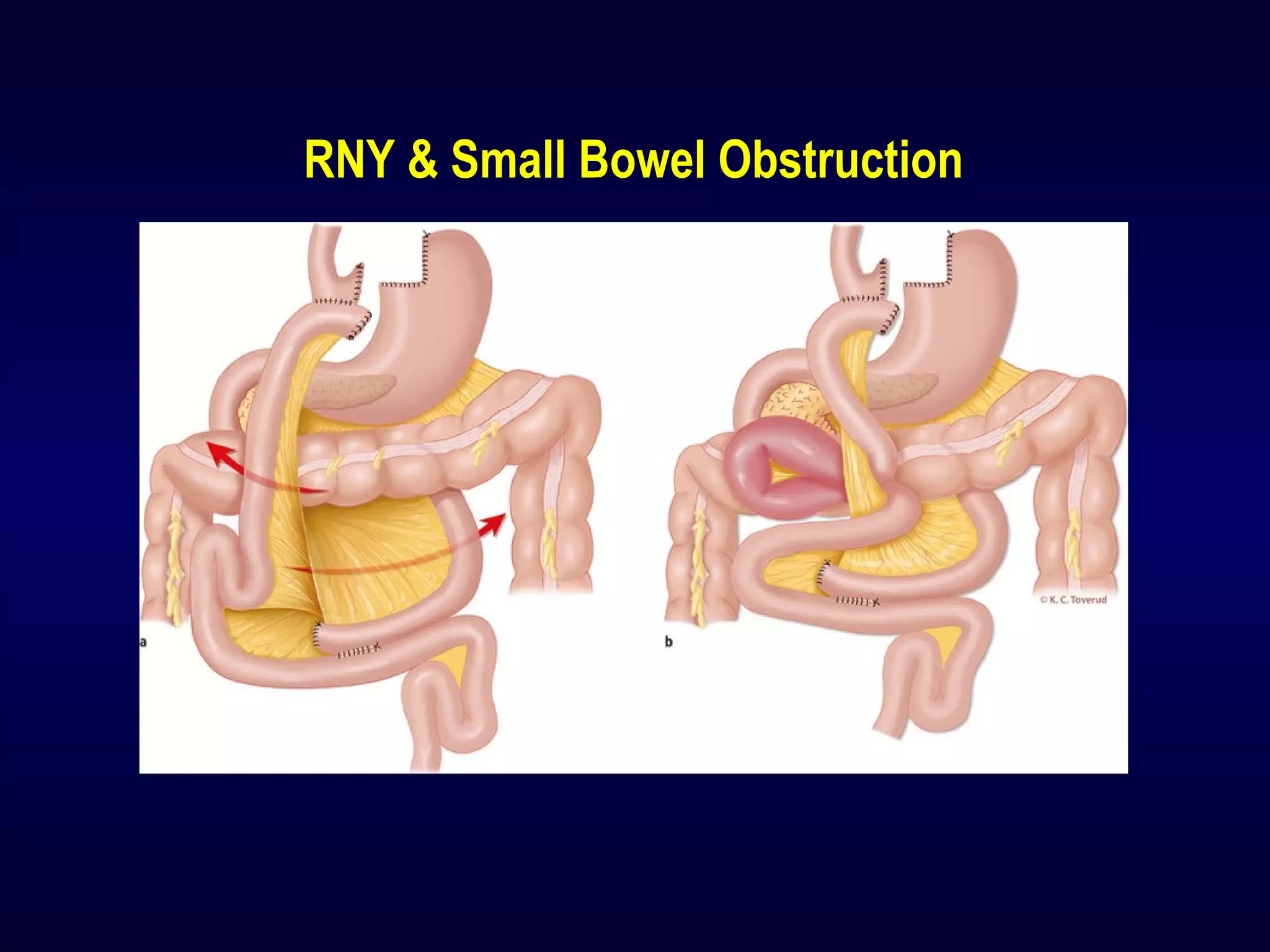 RNY & Small Bowel Obstruction
 