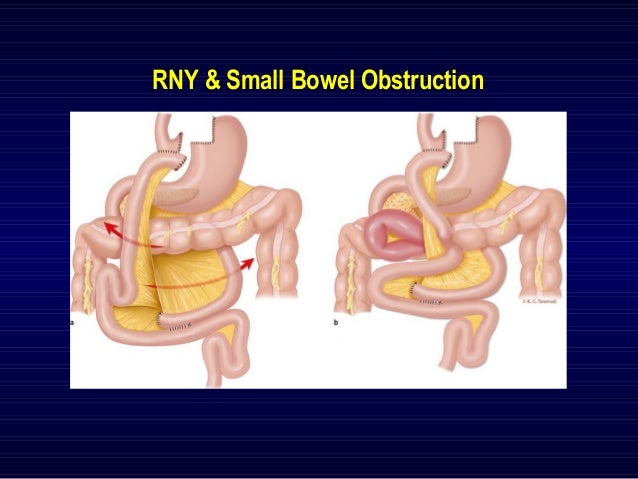 rny revisions