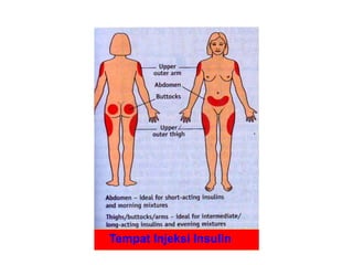 Tempat Injeksi Insulin
 