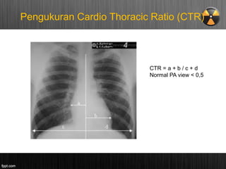 KULIAH RADIOGRAFI TORAKS NORMAL, blok 4.pdf