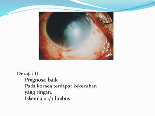 Derajat II
Prognosa baik
Pada kornea terdapat kekeruhan
yang ringan.
Iskemia < 1/3 limbus
 