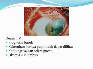 Derajat IV
 Prognosis buruk
 Kekeruhan kornea pupil tidak dapat dilihat
 Konjungtiva dan sclera pucat.
 Iskemia > ½ limbus
 