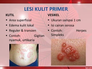 LESI KULIT PRIMER
KUTIL
• Area superfisial
• Edema kulit lokal
• Reguler & transien
• Contoh: Gigitan
nyamuk, urtikaria
VESIKEL
• Ukuran sampai 1 cm
• Isi cairan serosa
• Contoh: Herpes
Simpleks
 