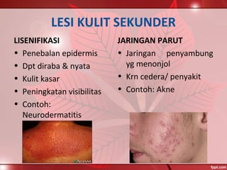 LESI KULIT SEKUNDER
LISENIFIKASI
• Penebalan epidermis
• Dpt diraba & nyata
• Kulit kasar
• Peningkatan visibilitas
• Contoh:
Neurodermatitis
JARINGAN PARUT
• Jaringan penyambung
yg menonjol
• Krn cedera/ penyakit
• Contoh: Akne
 