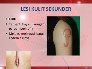 LESI KULIT SEKUNDER
KELOID
• Terbentuknya jaringan
parut hipertrofik
• Meluas melewati batas
cedera aslinya
 
