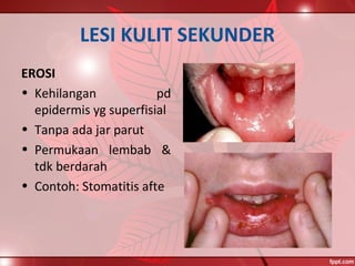 LESI KULIT SEKUNDER
EROSI
• Kehilangan pd
epidermis yg superfisial
• Tanpa ada jar parut
• Permukaan lembab &
tdk berdarah
• Contoh: Stomatitis afte
 
