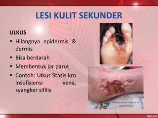 LESI KULIT SEKUNDER
ULKUS
• Hilangnya epidermis &
dermis
• Bisa berdarah
• Membentuk jar parut
• Contoh: Ulkus Stasis krn
insufisiensi vena,
syangker sifilis
 