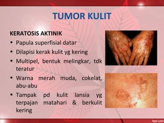 TUMOR KULIT
KERATOSIS AKTINIK
• Papula superfisial datar
• Dilapisi kerak kulit yg kering
• Multipel, bentuk melingkar, tdk
teratur
• Warna merah muda, cokelat,
abu-abu
• Tampak pd kulit lansia yg
terpajan matahari & berkulit
kering
 