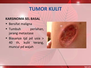 TUMOR KULIT
KARSINOMA SEL BASAL
• Bersifat maligna
• Tumbuh perlahan,
jarang metastase
• Biasanya tjd pd usia >
40 th, kulit terang,
muncul pd wajah
 