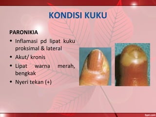 KONDISI KUKU
PARONIKIA
• Inflamasi pd lipat kuku
proksimal & lateral
• Akut/ kronis
• Lipat warna merah,
bengkak
• Nyeri tekan (+)
 