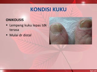 KONDISI KUKU
ONIKOLISIS
• Lempeng kuku lepas tdk
terasa
• Mulai dr distal
 