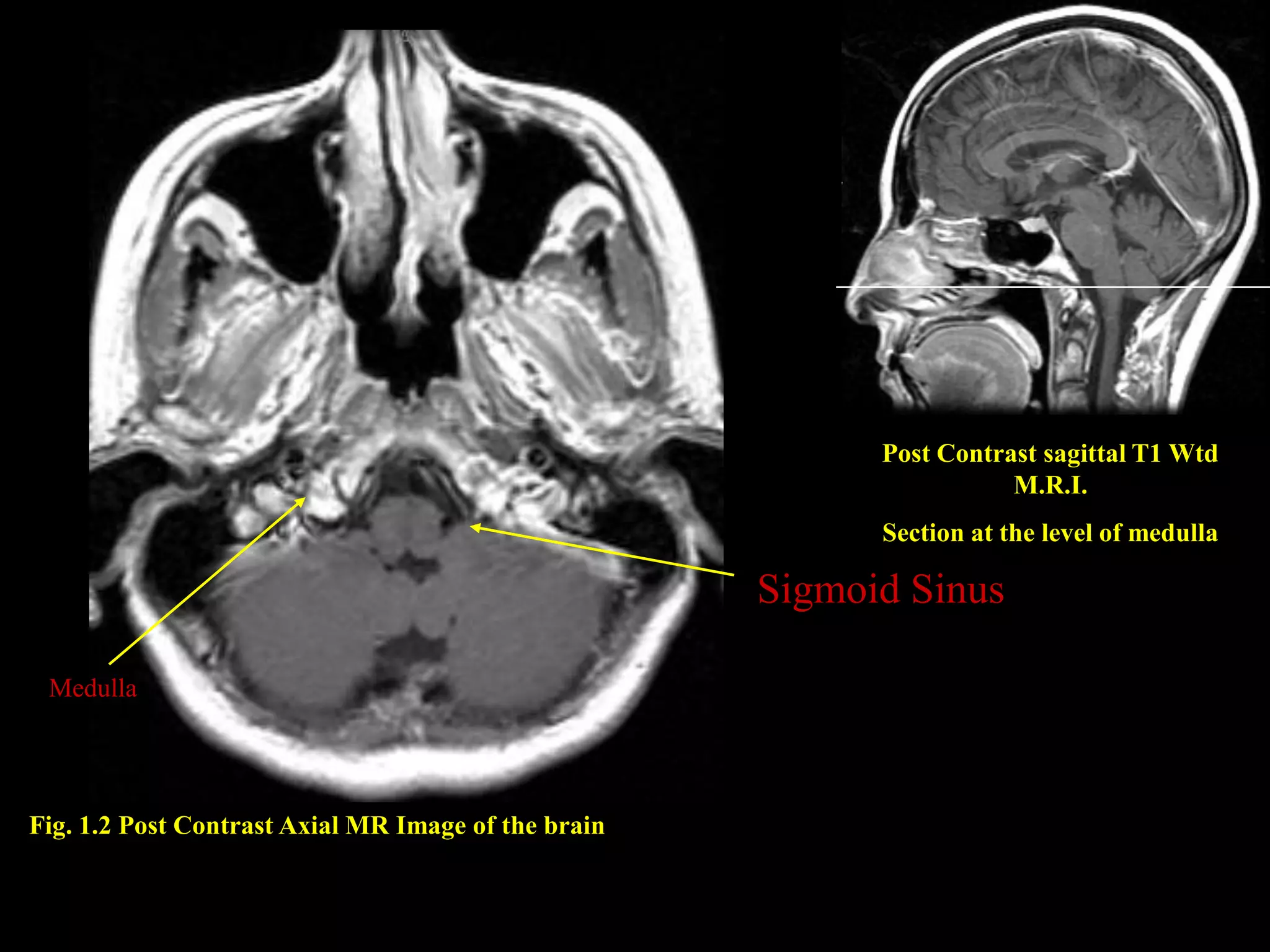 MRI SECTIONAL ANATOMY OF BRAIN | PPTX