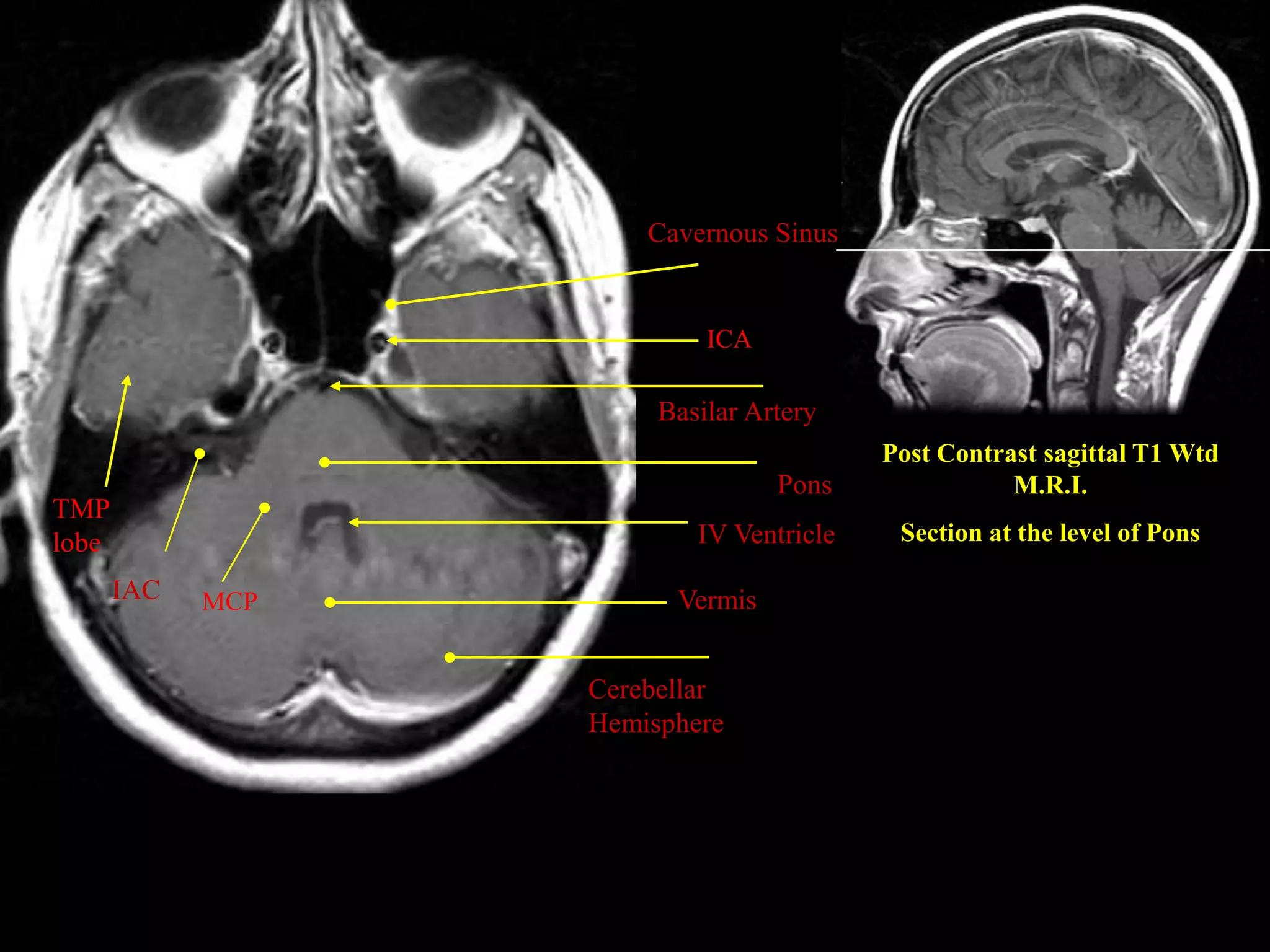MRI SECTIONAL ANATOMY OF BRAIN | PPTX
