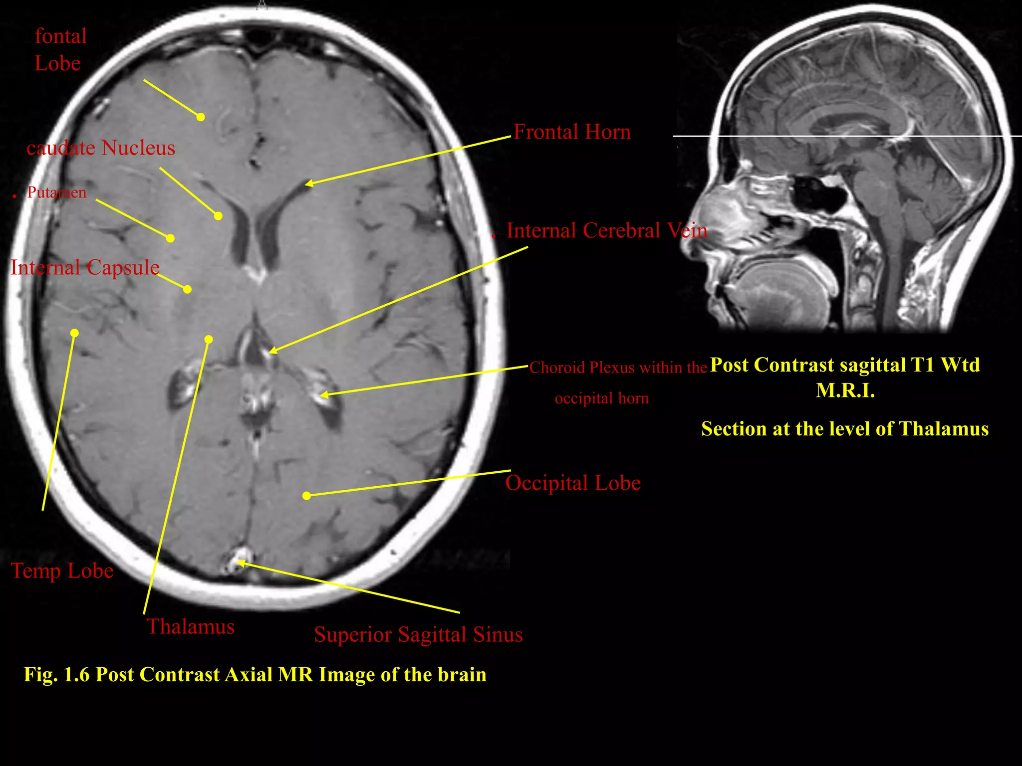MRI SECTIONAL ANATOMY OF BRAIN PPTX