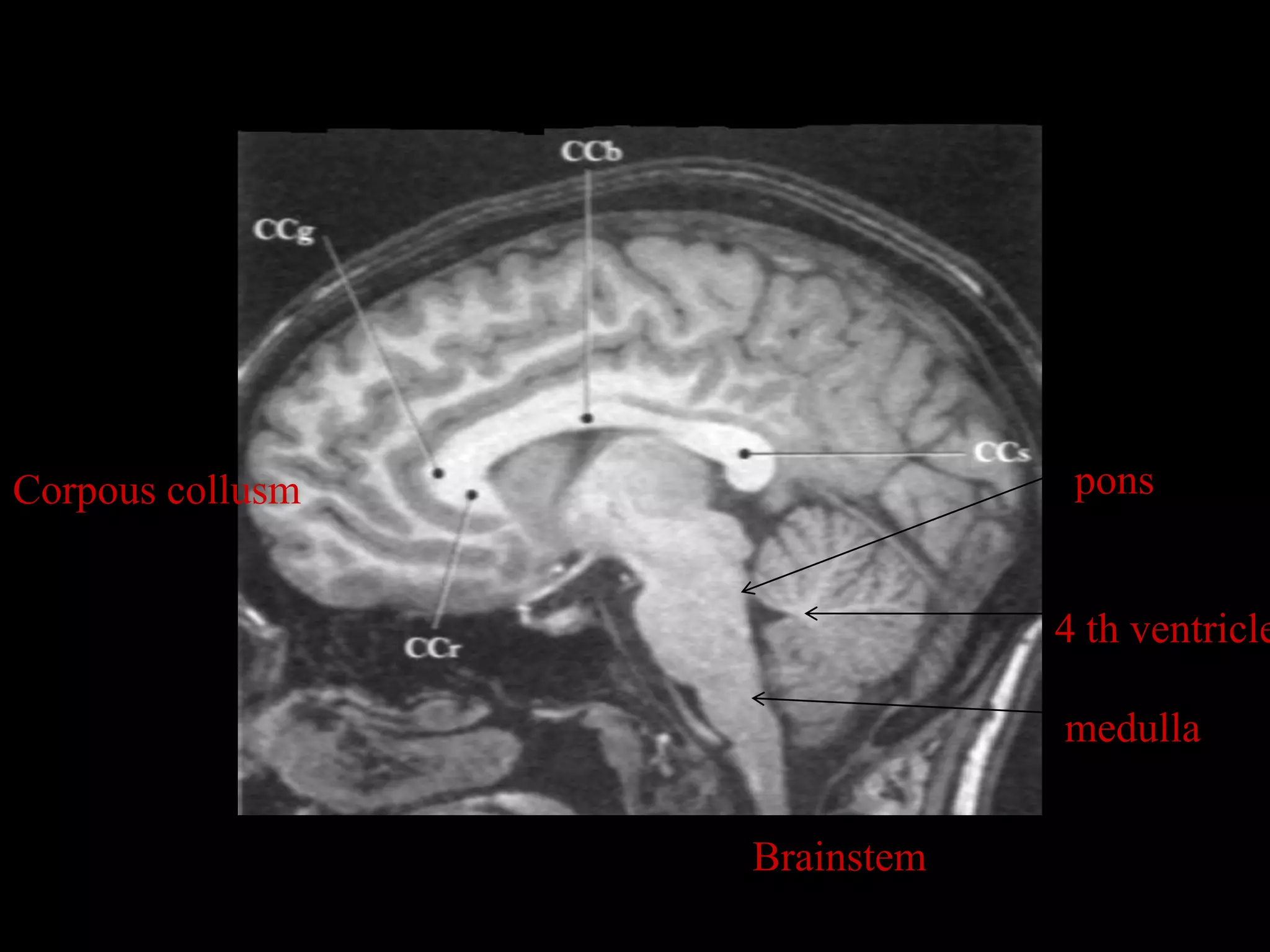 MRI SECTIONAL ANATOMY OF BRAIN | PPTX