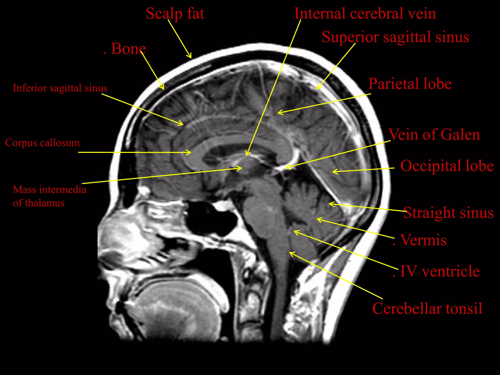 MRI SECTIONAL ANATOMY OF BRAIN PPTX