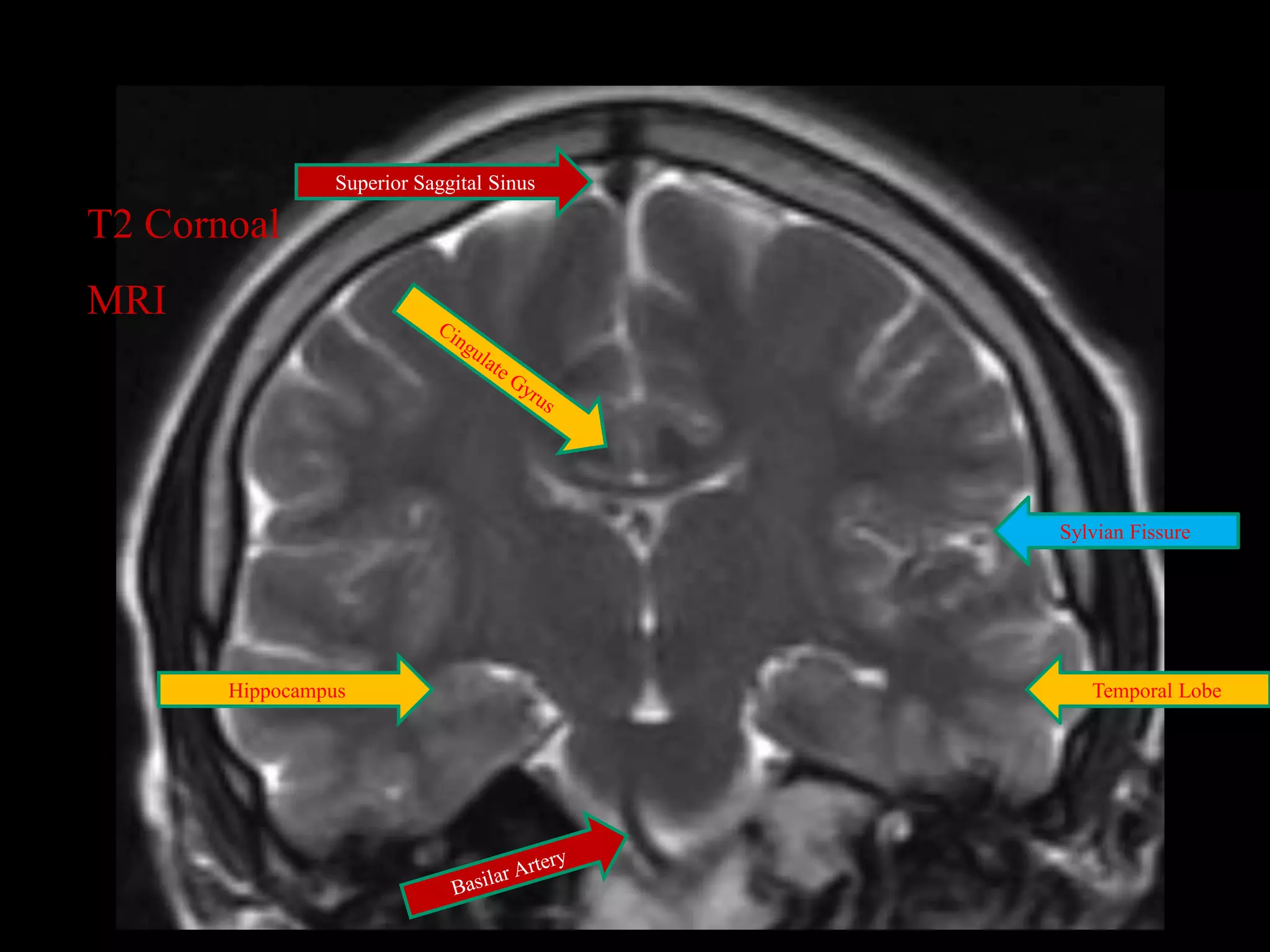 MRI SECTIONAL ANATOMY OF BRAIN | PPTX