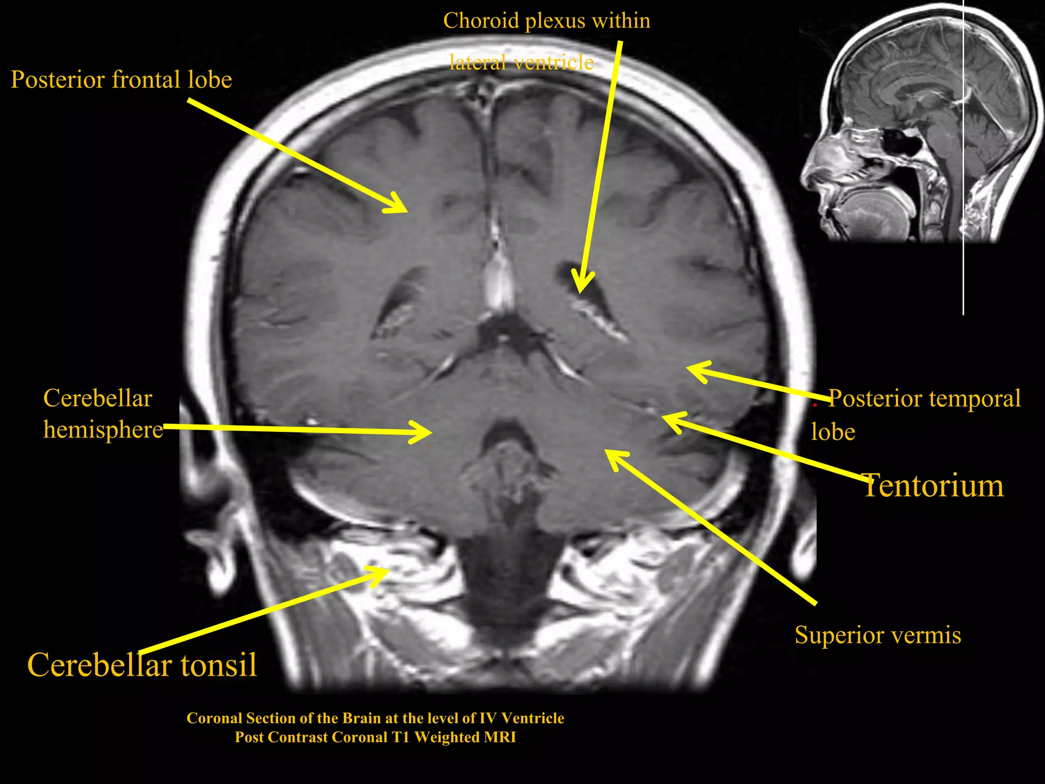 MRI SECTIONAL ANATOMY OF BRAIN | PPTX