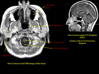 . Maxillary
                                              Sinus




                                                  . Nasopharynx

                                                                        Post Contrast sagittal T1 Weighted
                                                                                      M.R.I.
                                                                         Section at the level of Foramen
                                                   . Cervical Cord                   Magnum

                                                       Cisterna Magna


. Mandible

      Post Contrast Axial MR Image of the brain
 