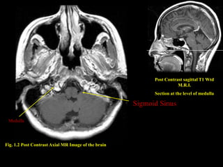 Post Contrast sagittal T1 Wtd
                                                                      M.R.I.
                                                           Section at the level of medulla

                                                     Sigmoid Sinus

 Medulla




Fig. 1.2 Post Contrast Axial MR Image of the brain
 