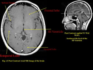 Sylvian Fissure


                                                      Frontal lobe




                                                        III Ventricle   Post Contrast sagittal T1 Wtd
                                                                                   M.R.I.
                                                                          Section at the level of the
                                                                                III Ventricle



                                                  Occipital Lobe


Temporal Lobe
 Fig. 1.5 Post Contrast Axial MR Image of the brain
 