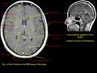 fontal
  Lobe


                                                        Frontal Horn
 caudate Nucleus
. Putamen
                                                      . Internal Cerebral Vein
Internal Capsule



                                                          Choroid Plexus within the Post Contrast
                                                                                                sagittal T1 Wtd
                                                             occipital horn                   M.R.I.
                                                                               Section at the level of Thalamus

                                                       Occipital Lobe


Temp Lobe

              Thalamus          Superior Sagittal Sinus
 Fig. 1.6 Post Contrast Axial MR Image of the brain
 