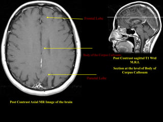 Frontal Lobe




                                            Body of the Corpus Callosum
                                                                 Post Contrast sagittal T1 Wtd
                                                                            M.R.I.
                                                                 Section at the level of Body of
                                                                       Corpus Callosum
                                              Parietal Lobe




Post Contrast Axial MR Image of the brain
 