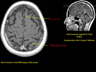 Frontal Lobe




                                                             Post Contrast sagittal T1 Wtd
                                                                        M.R.I.
                                                           Section above the Corpus Callosum

                                            Parietal Lobe




Post Contrast Axial MR Image of the brain
 