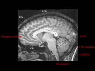 Corpous collusm                pons


                              4 th ventricle

                              medulla


                  Brainstem
 